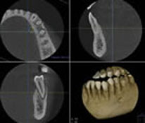 CTによる精密診断