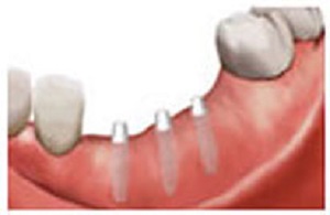 フラップレス後