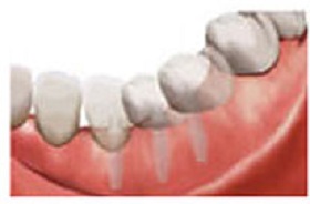 イミディエイト術式