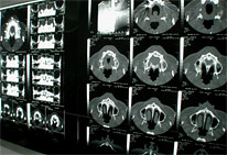 インプラント治療