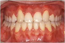 下顎前突・受け口1治療後