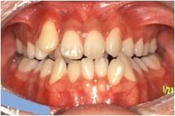 下顎前突・受け口1治療前