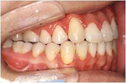 下顎前突・受け口2治療後