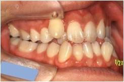 下顎前突・受け口2治療前