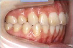 上顎前突・出っ歯1治療後