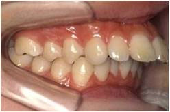 上顎前突・出っ歯1治療前