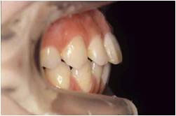 上顎前突・出っ歯2治療後