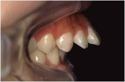 上顎前突・出っ歯2治療前