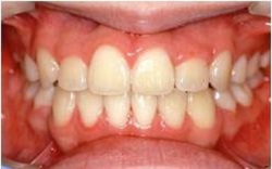 叢生・乱杭歯1治療後
