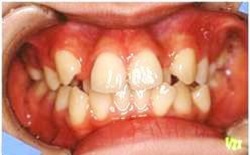 叢生・乱杭歯1治療前