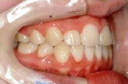 叢生・乱杭歯2治療後