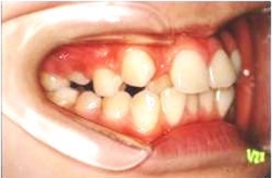 叢生・乱杭歯2治療前