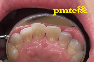 PMTC治療後