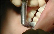 PMTCクリーニング