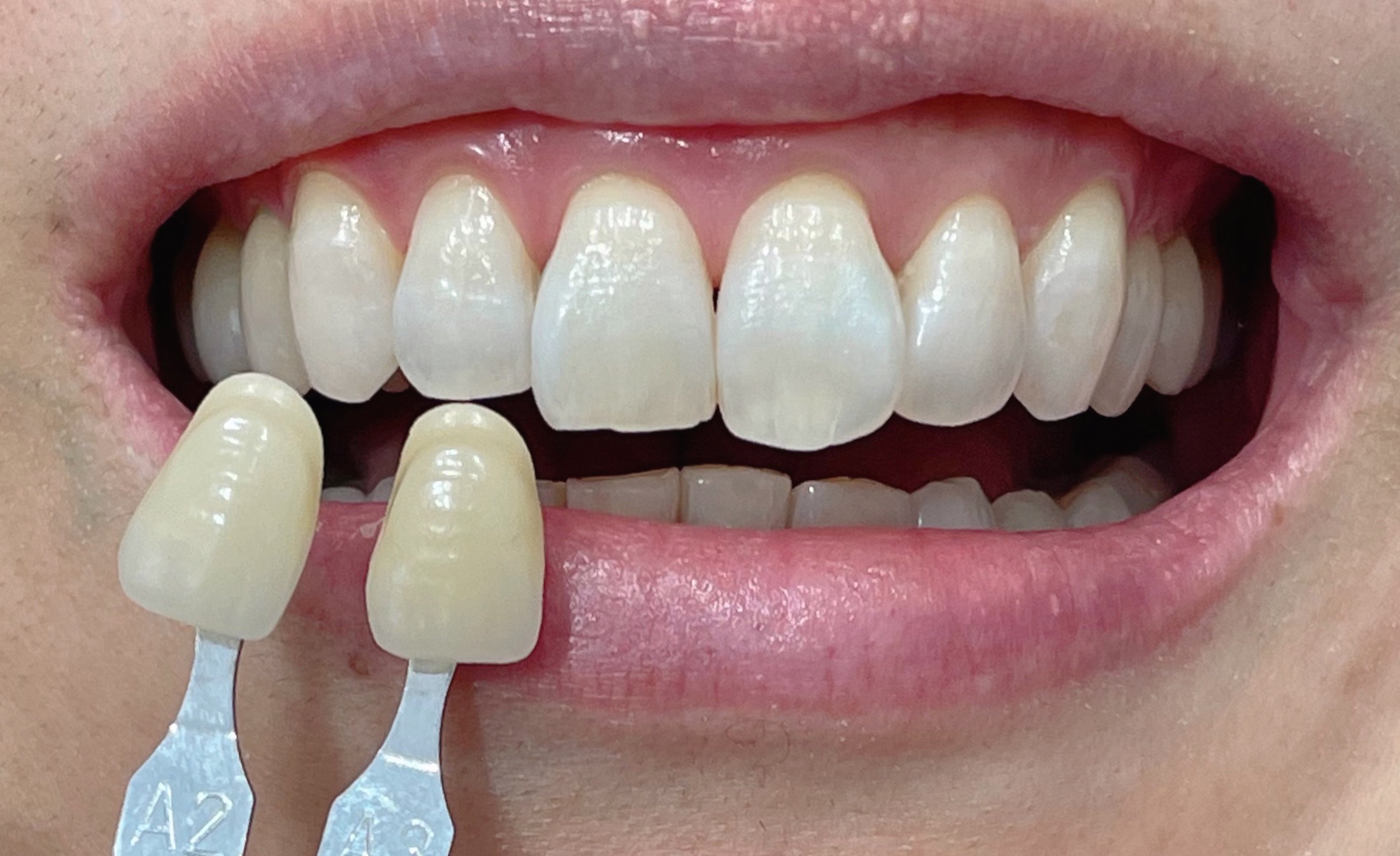 ホワイトニング症例