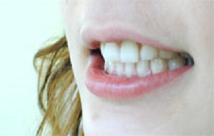 ホワイトニング